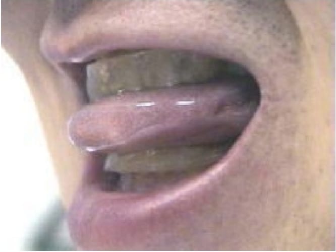 口腔内装置（マウスピース）